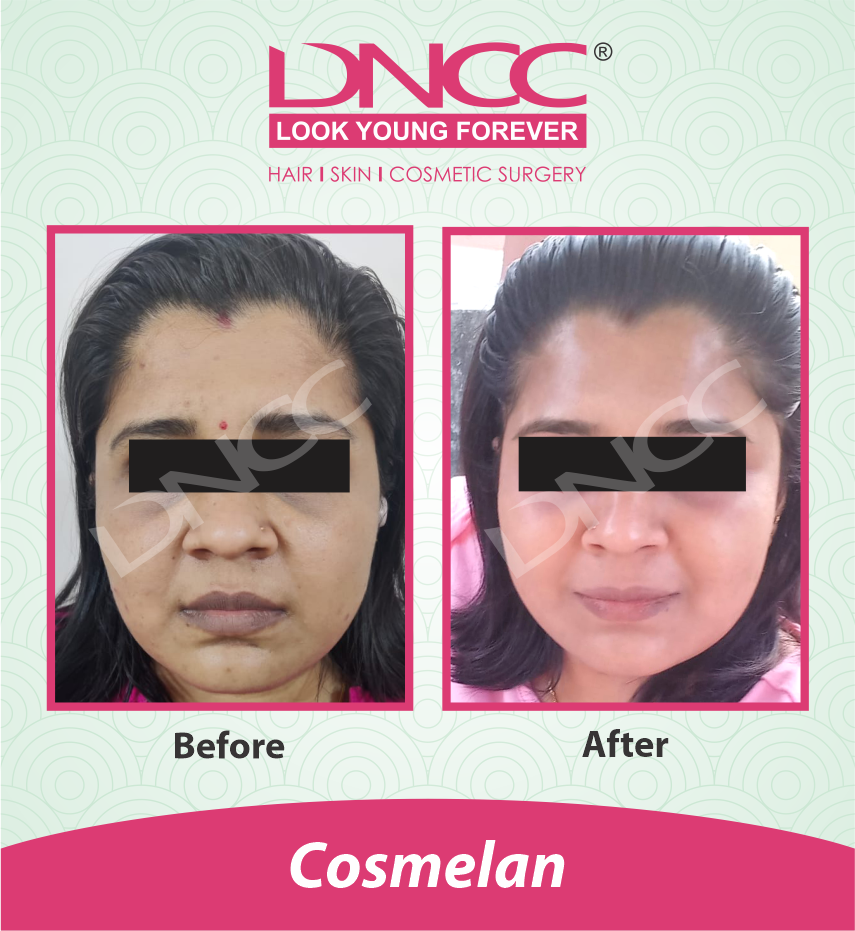 Hair Transplant Transformation 1